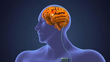 Deep Brain Stimulation (DBS): A New Frontier for Movement Disorders