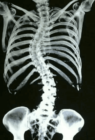 Deciphering Adult Spinal Deformity: The Threshold for Reconstructive Surgery