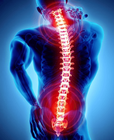 Cervical Spondylotic Myelopathy: The Silent Progression of Spinal Cord Compression
