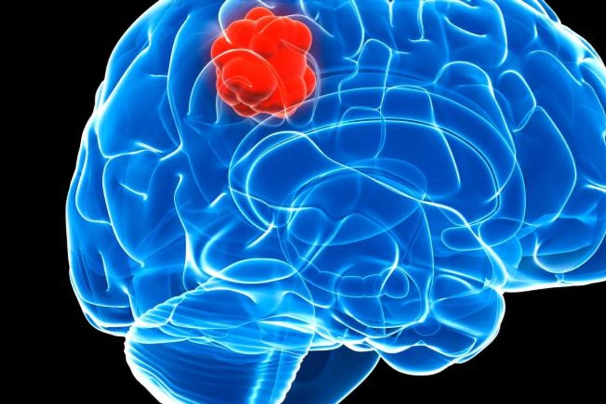 Neurosurgeon planning brain tumor surgery using neuro-navigation