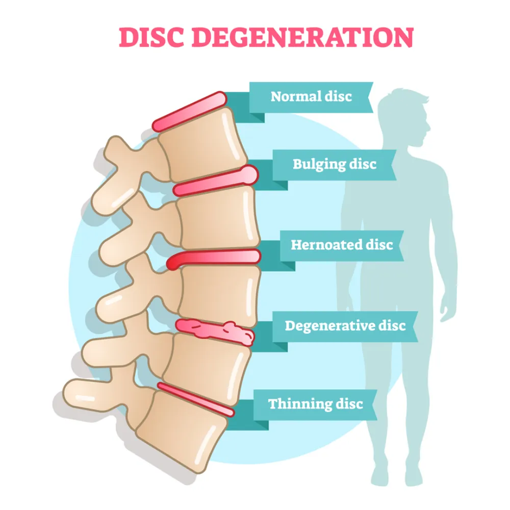 disc generation