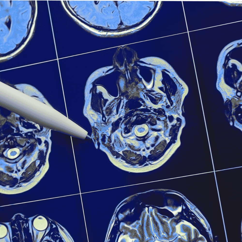 How Is A Brain Tumour Different From A Brain Lesion?