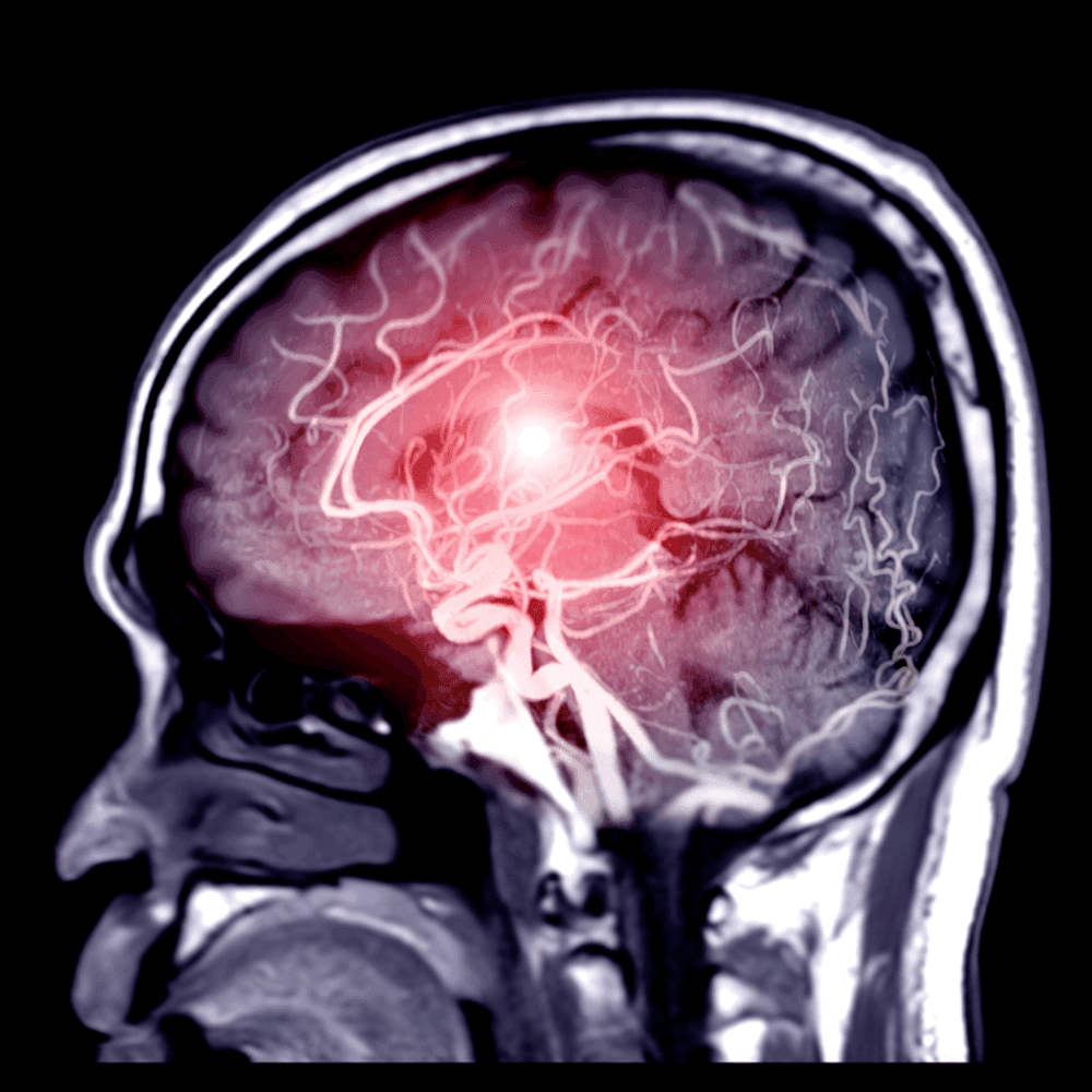 What are the early signs and symptoms of brain tumours in adults?