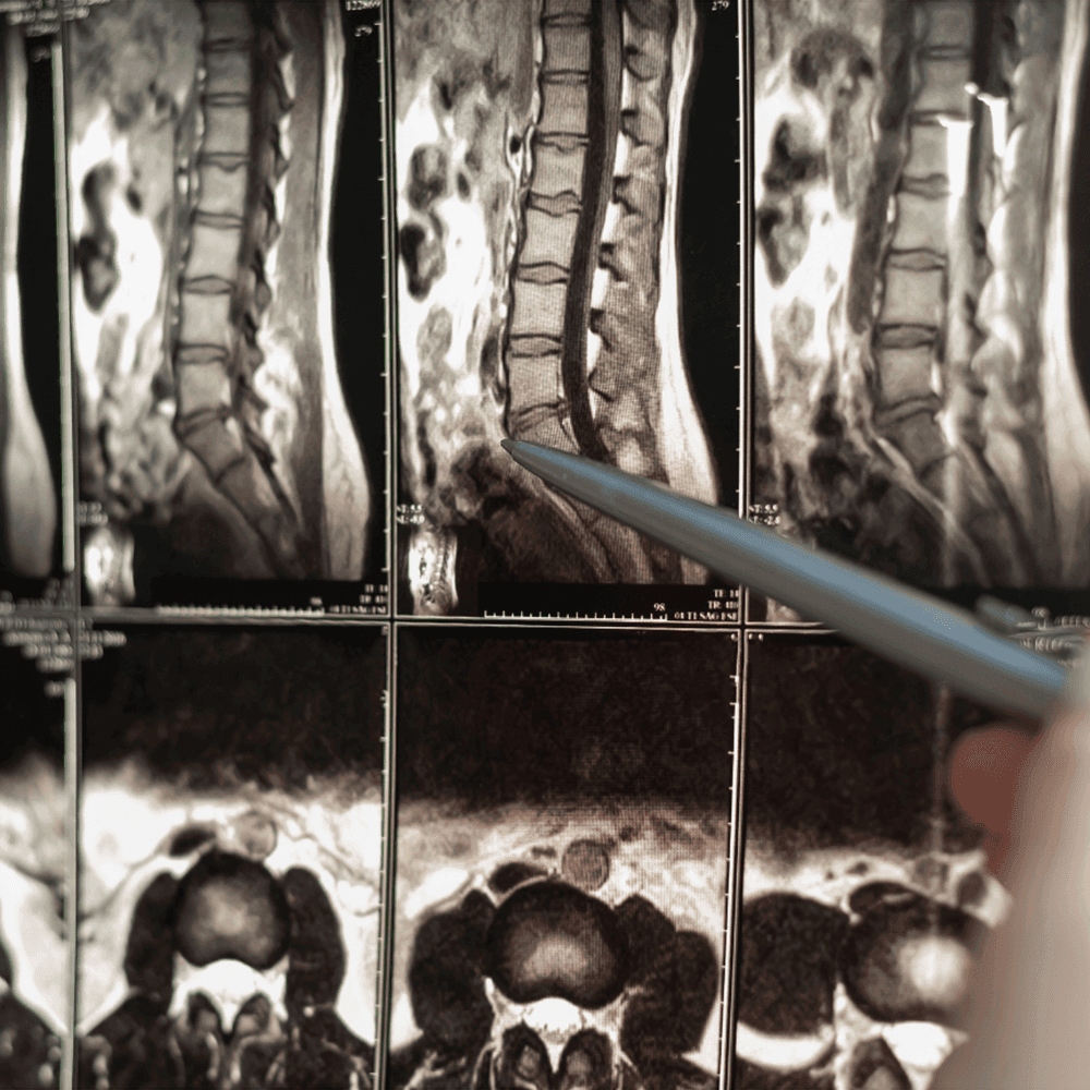 what is a complete vs incomplete spinal cord injury