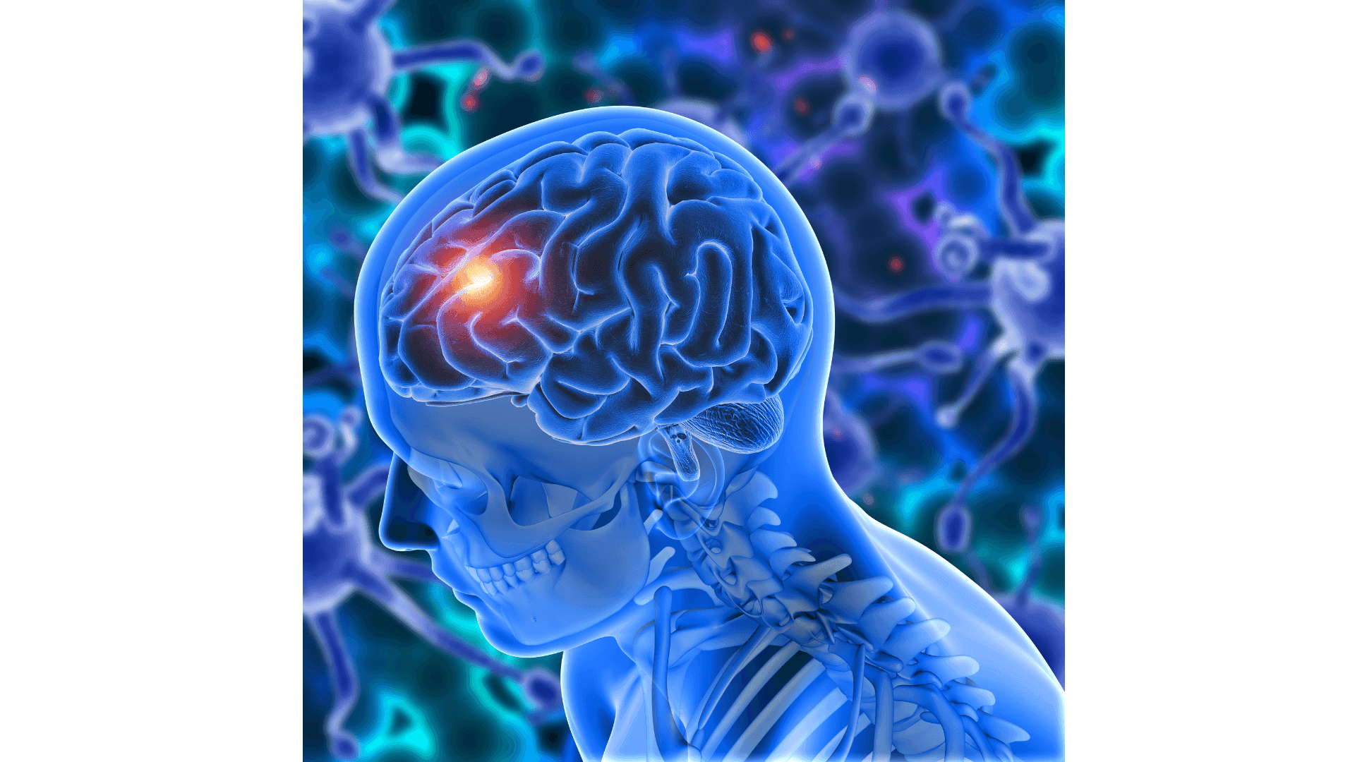 Brain Tumours: What Can DNA Tell Us?