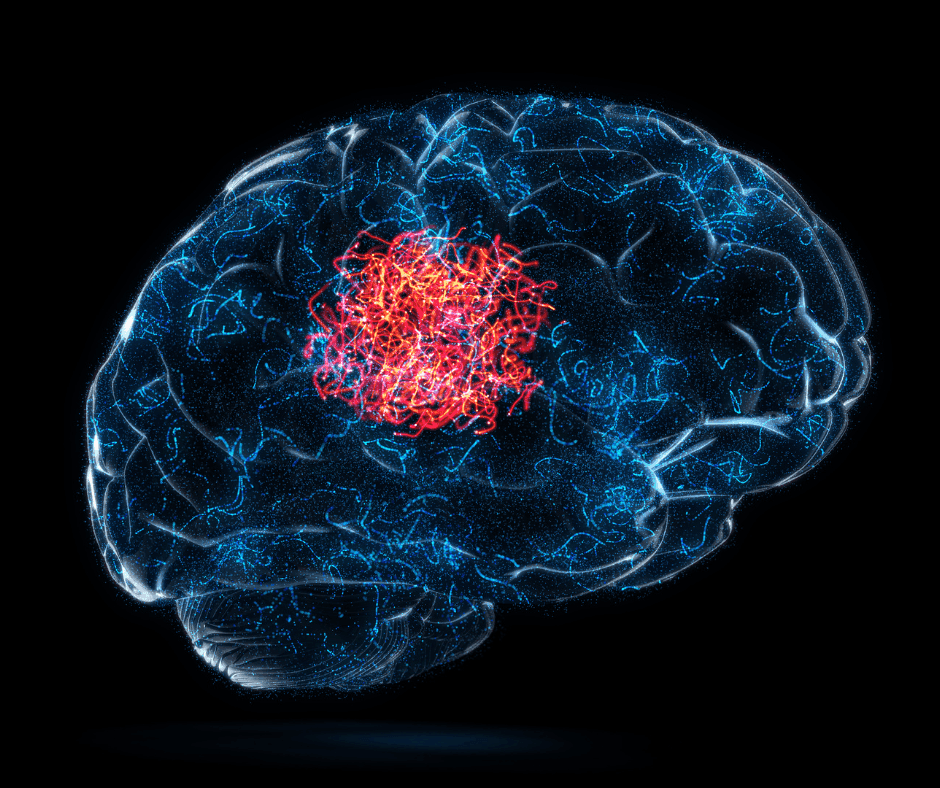 Brain Tumors and Mood Swings: The Surprising Connection