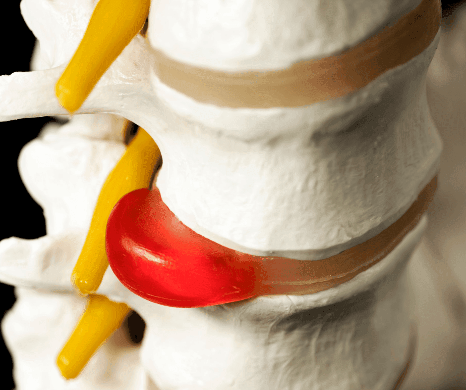 Slipped Disc Ruining Your Life? Here’s How Microdiscectomy Gets You Back on Your Feet