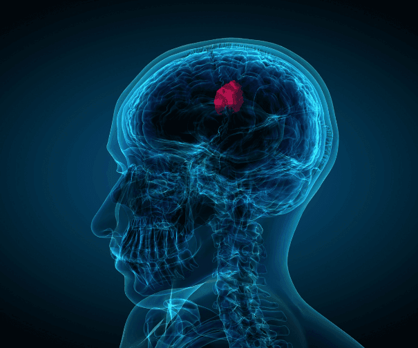 How Immunotherapy Is Emerging as a Supportive Therapy in Brain Tumor Management