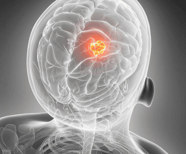 Metastatic Brain Tumors: How Neurosurgeons Manage Secondary Brain Cancer