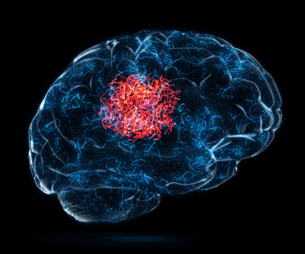 Recurrent Brain Tumors: When to Reoperate and When to Shift Strategy