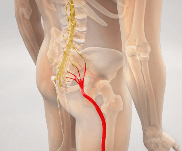 Sciatica and Microdiscectomy: How Small Procedures Relieve Big Pain