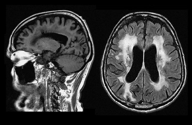 Hydrocephalus in Adults: Recognizing the Classic Triad of NPH