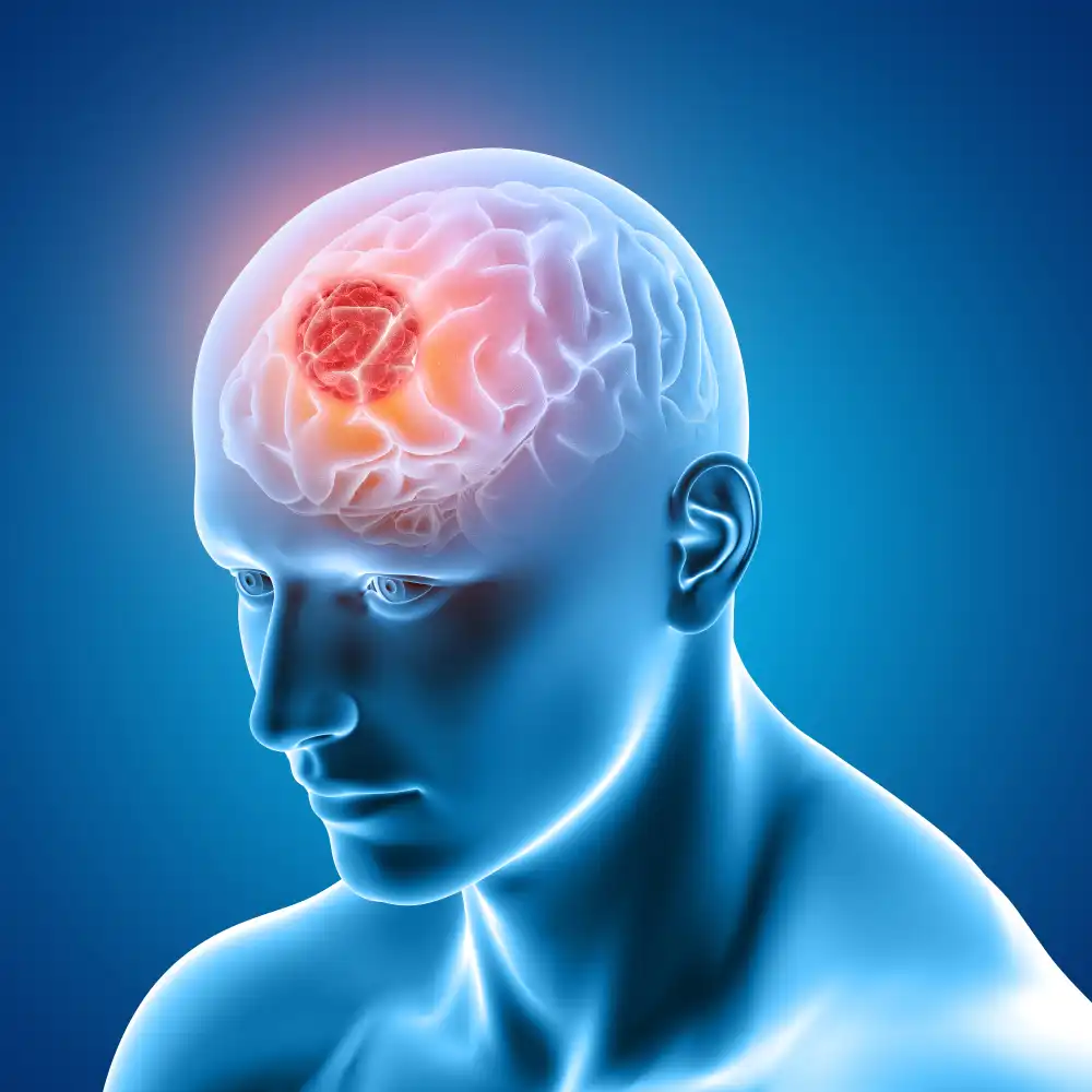 brain tumour