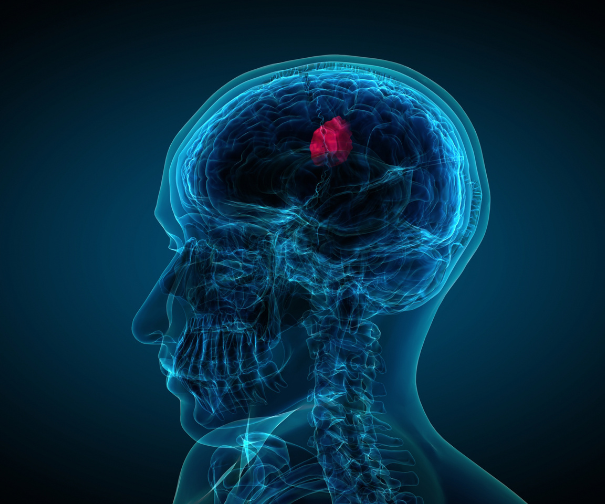 Stroke Paralysis Recovery and Surgery Guide