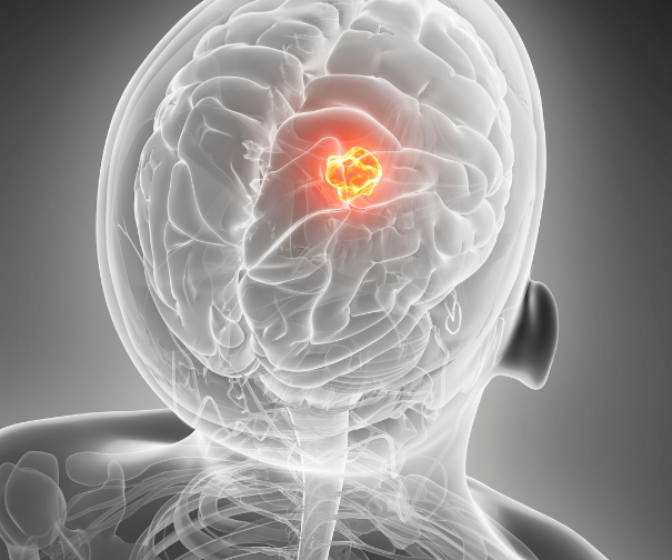 Stroke Paralysis Recovery and Surgery Guide