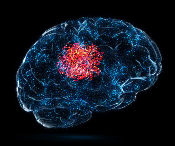 Stroke Paralysis Recovery and Surgery Guide