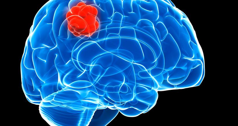 Brain Tumour