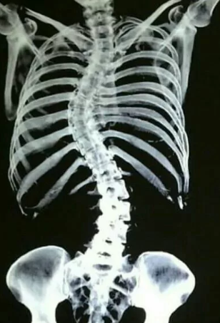  MRI Adult Spine